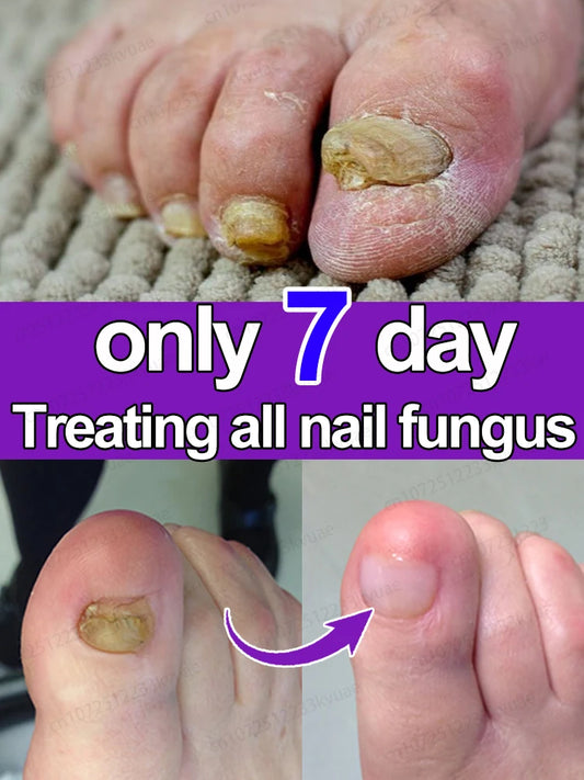 7-Day Nail Fungus Treatment Oil - Repair Onychomycosis Fast