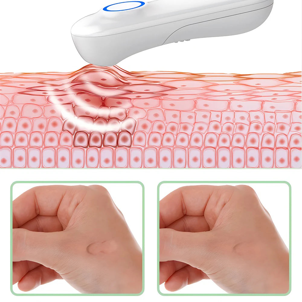 Electronic Mosquito Bite Pen Relief Burning Pain & Swelling Relieve Stings Pen Adult Children Anti-Mosquito Itch Stick Stop Pen