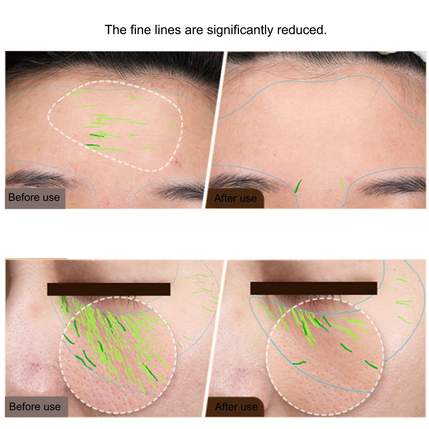 EMS RF Skin Tightening & Face Lifting Device - Professional Anti-Aging | AlluCanFind