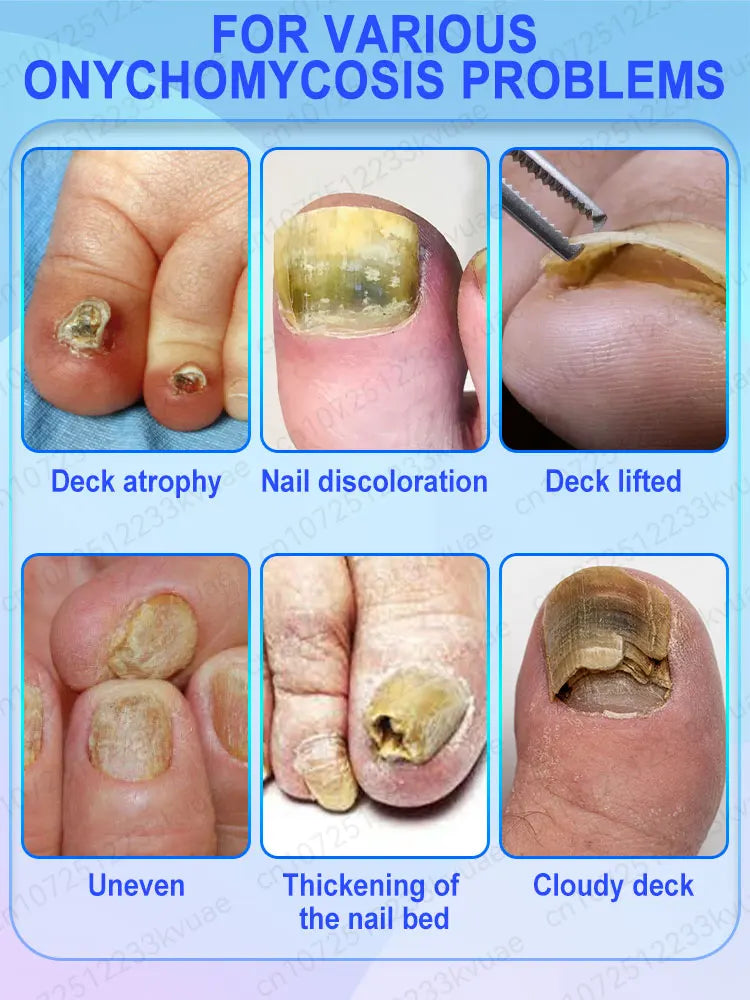 7-Day Nail Fungus Treatment Oil - Repair Onychomycosis Fast