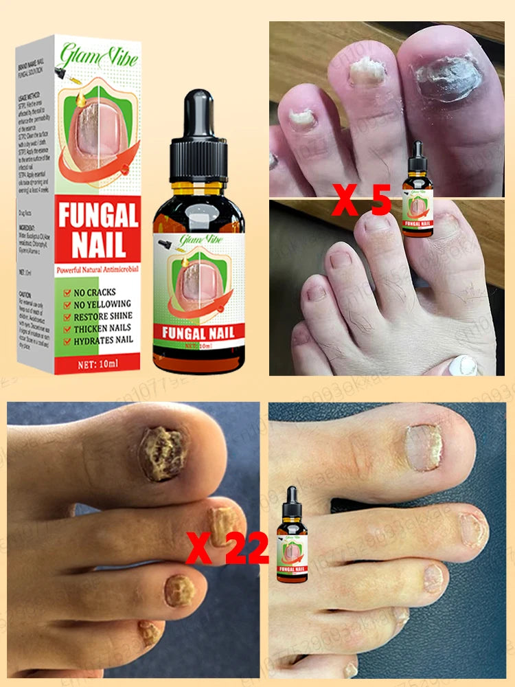 7-Day Nail Fungus Treatment Oil - Repair Onychomycosis Fast