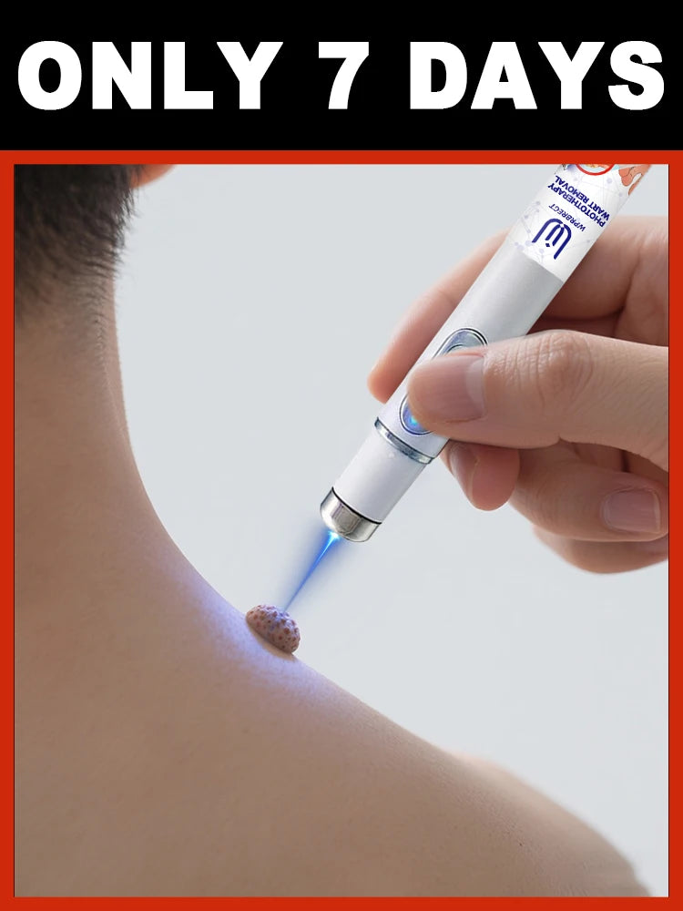 ᵂᵃʳᵗ ʳᵉᵐᵒᵛᵃˡ ᵃᵗ ʰᵒᵐᵉ ⁱˢ ˢᵘᵖᵉʳ ᶜᵒⁿᵛᵉⁿⁱᵉⁿᵗ! Warts will gradually fall off in 7 days