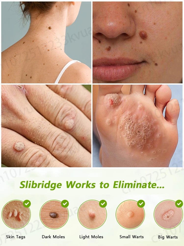 ᵂᵃʳᵗ ʳᵉᵐᵒᵛᵃˡ ᵃᵗ ʰᵒᵐᵉ ⁱˢ ˢᵘᵖᵉʳ ᶜᵒⁿᵛᵉⁿⁱᵉⁿᵗ! Warts will gradually fall off in 7 days