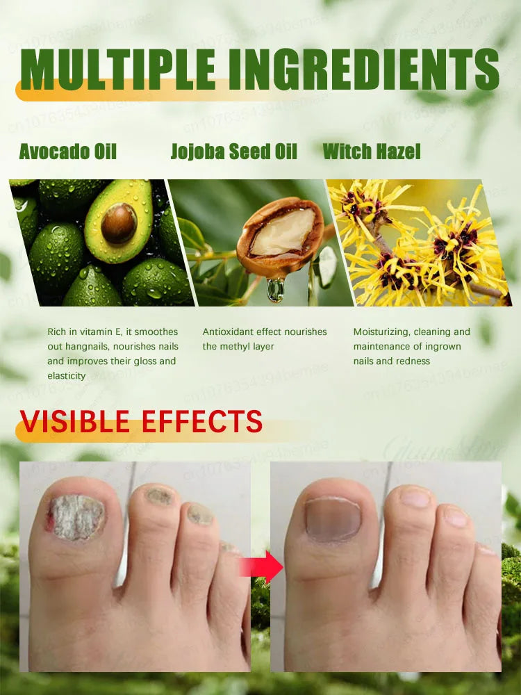 7-Day Nail Fungus Treatment Oil - Repair Onychomycosis Fast